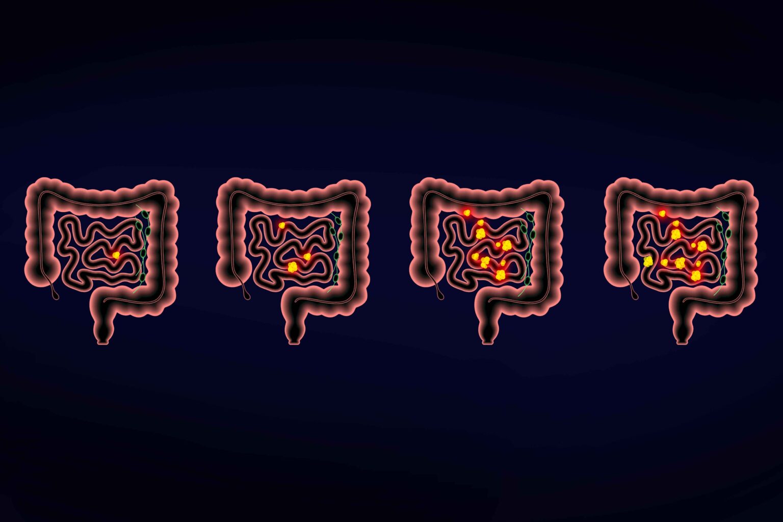 Stades du cancer de l