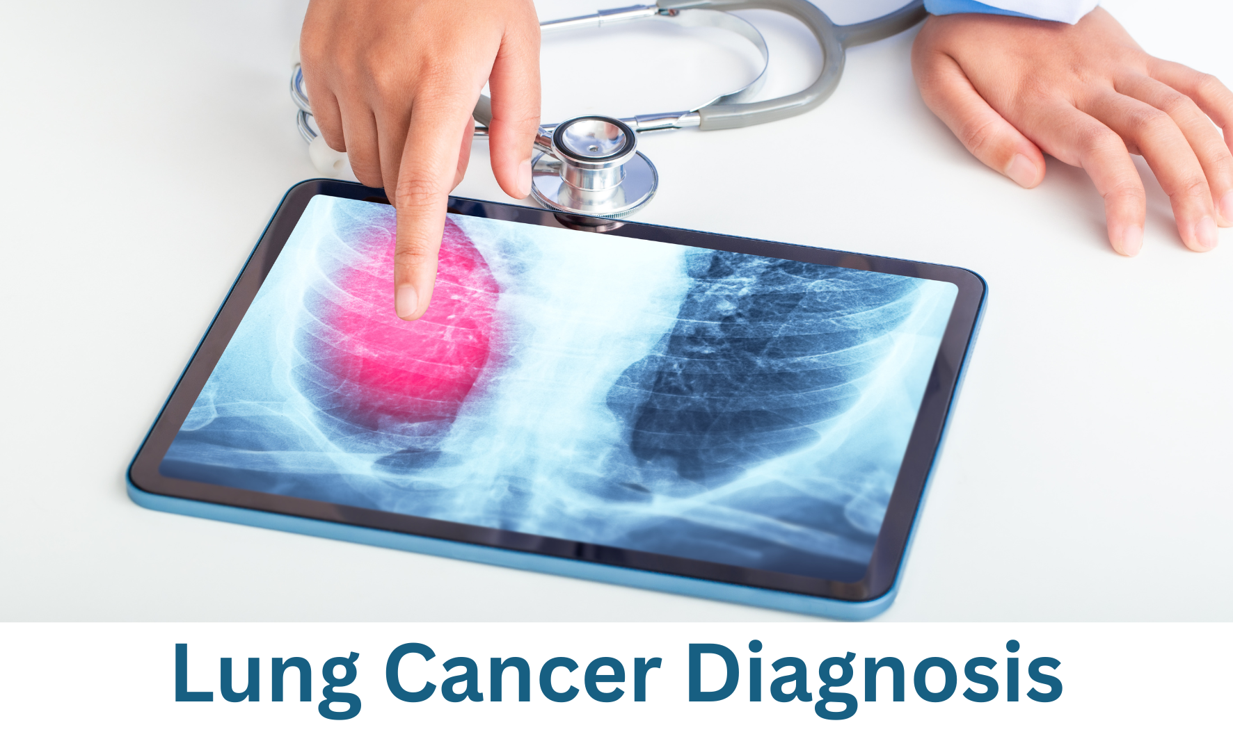 Lung Cancer Diagnosis - Proton Therapy