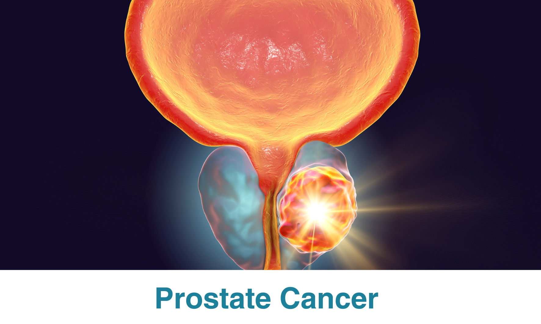 Prostate Cancer: Comprehensive Guide - Proton Therapy