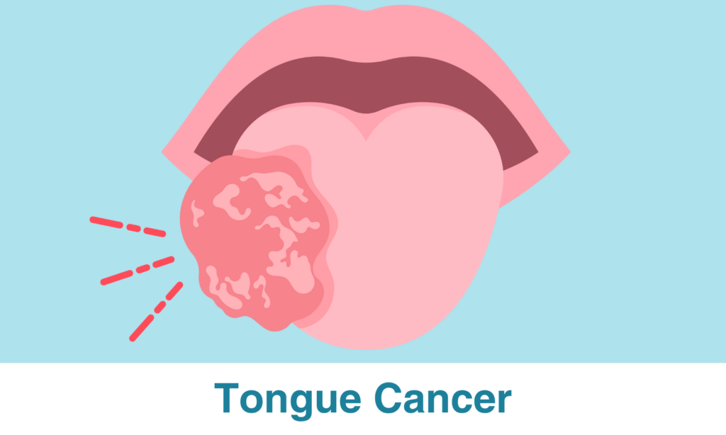 Repérer les signes détection précoce du cancer de la langue Protonthérapie
