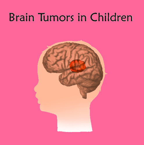 Pediatric Brain Tumor - Symptoms, Causes, and Treatment Cost in India ...