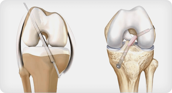 ACL reconstruction surgery illustration
