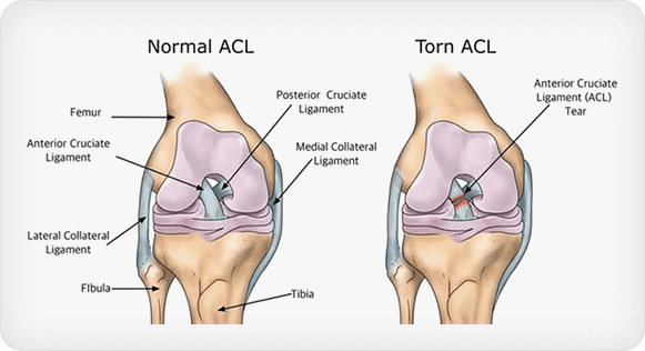 ACL injury illustration