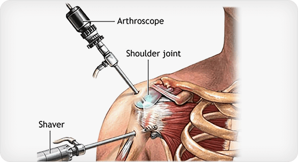 Shoulder Arthroscopy Procedure