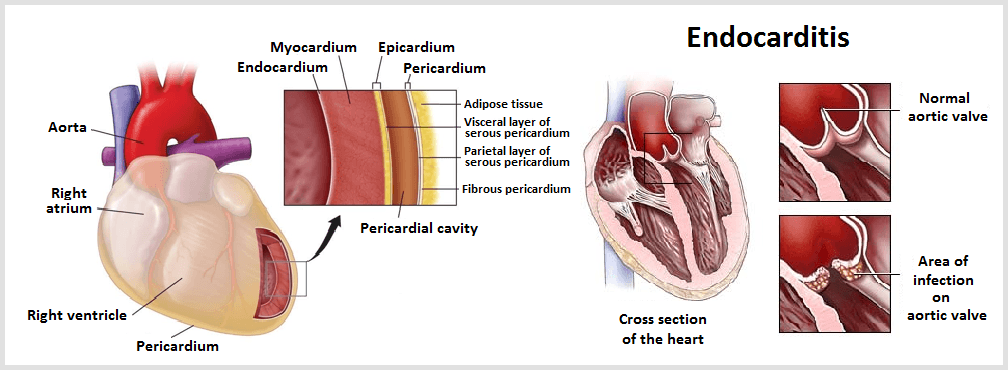 Endocarditis