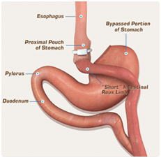 Banded Bypass