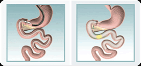 Intragastric Balloon