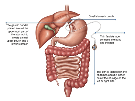 Laparoscopic Adjustable Gastric Banding