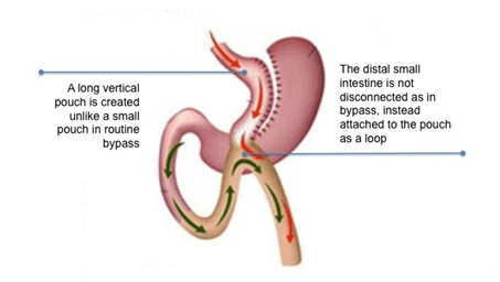 Minigastric bypass