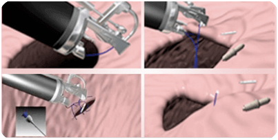 Endoscopic Bariatric Surgery