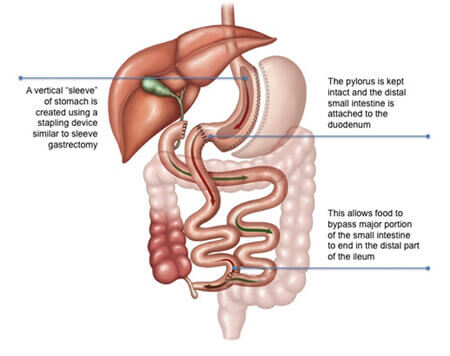 Bilio Pancreatic