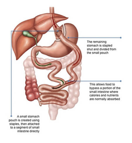 Gastric Bypass