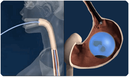 Intragastric Balloon