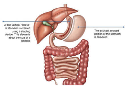 Procedure - Sleeve gastrectomy