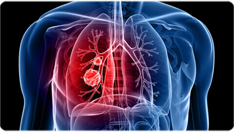 Lung Cancer Treatment