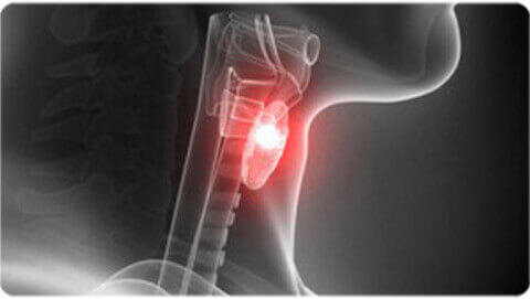 Thyroid Cancer Treatment in India at Apollo Hospitals