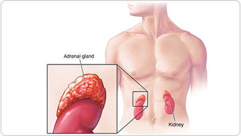 Neuroblastoma Cancer