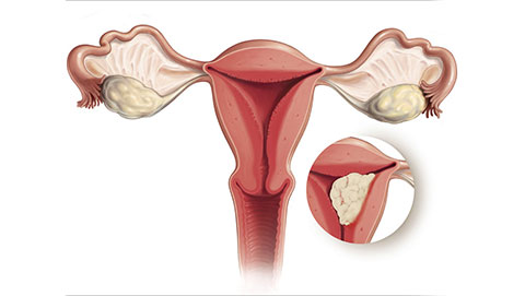 Endometrial Cancer Treatment in India at Apollo Hospitals