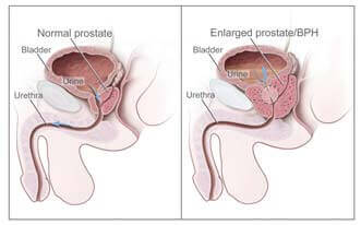 prostatitis indiában