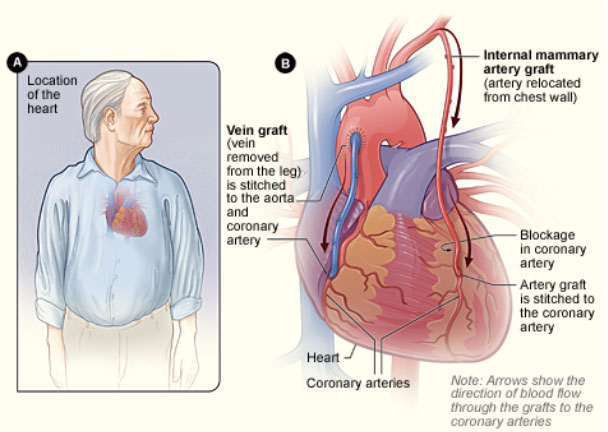 Coronary Artery Bypass Grafting Surgery At Apollo Hospitals