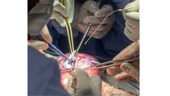 Highly Critical Myelomeningocele Surgery Procedure Saves Life Of a Baby