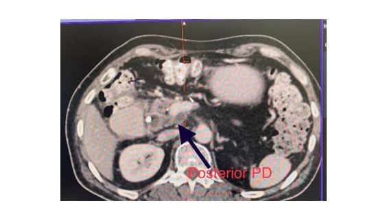Portal annular pancreas – A real challenge in patients undergoing Whipples’ pancreatico duodenectomy