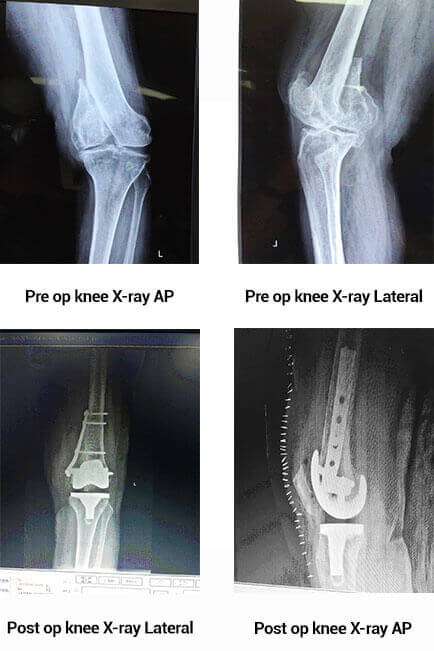 Total Knee Replacement