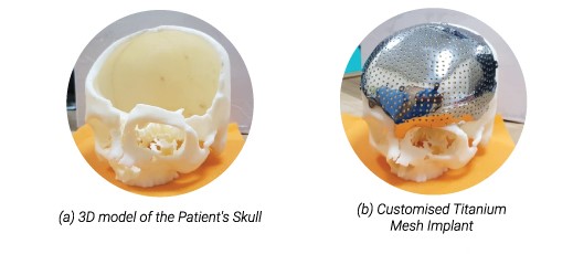 Apollo Hospitals, Navi Mumbai performed a 3D printed titanium skull implant surgery to save the life of a traumatic brain injury patient