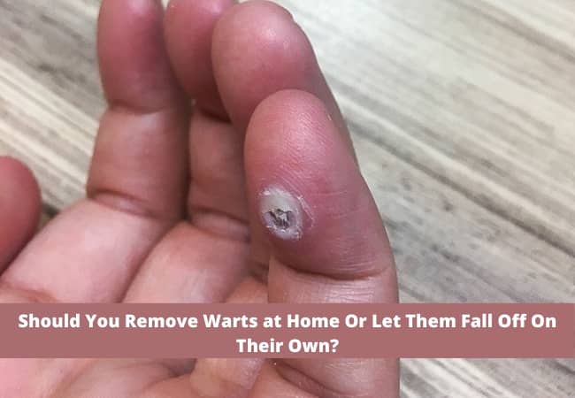 Should You Remove Warts at Home Or Let Them Fall Off On Their Own