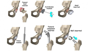 TOTAL HIP REPLACEMENT