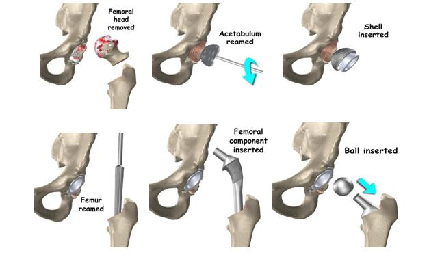 Avascular Necrosis of Femoral Head - Causes, Symptoms & Treatment