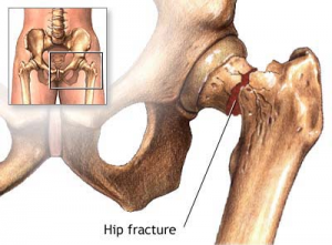 hip fracture