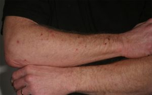 Contact Dermatitis Causes