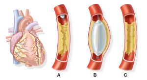 Heart Attack Treatments