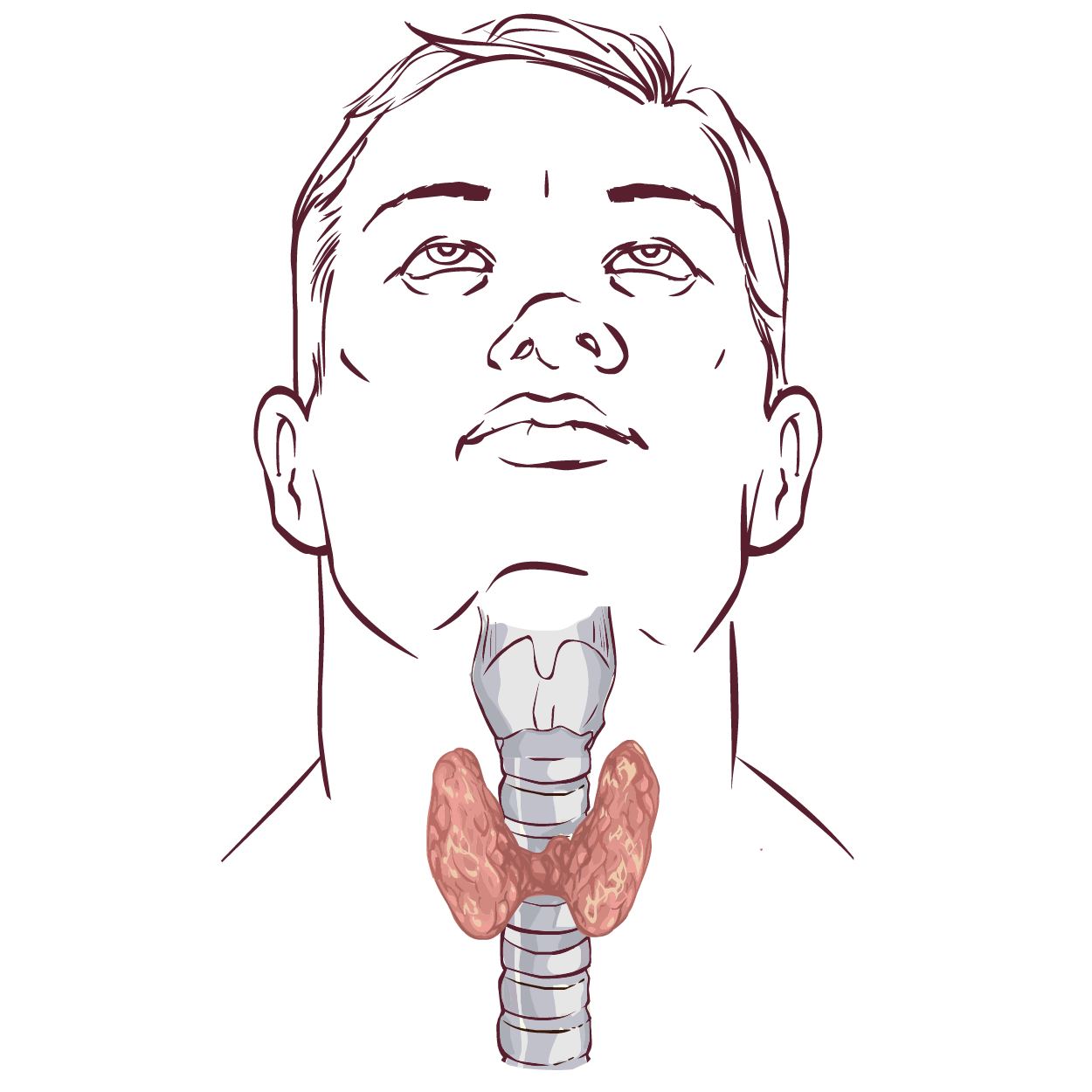 Hypothyroidism: Causes, Symptoms, Risk Factors and Treatment