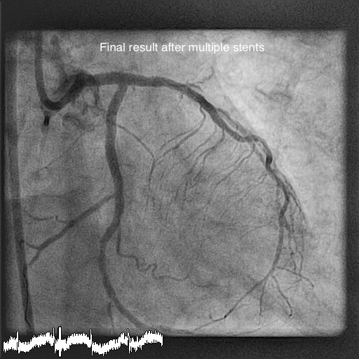 What is Rotablation Angioplasty