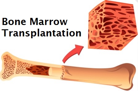 Bone Marrow Transplantation