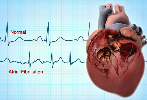 All You Need to Know about Atrial Fibrillation