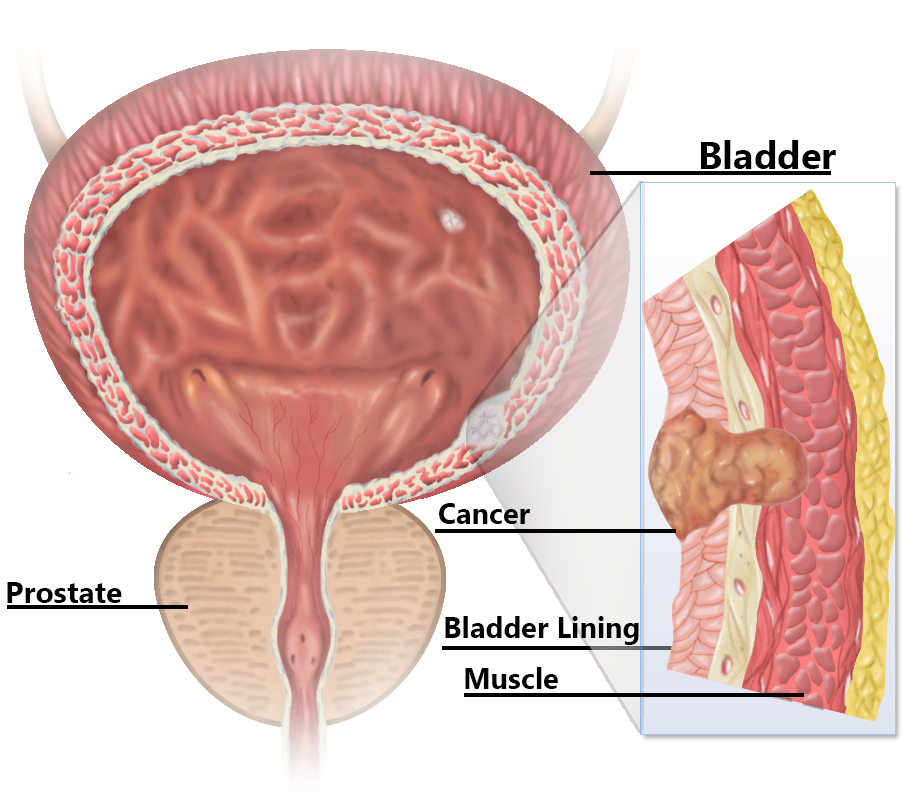 Bladder cancer – Symptoms and Causes