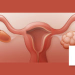 PCOD (Polycystic Ovarian Disease) & PCOS