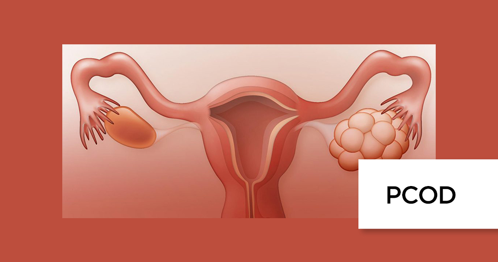 PCOD (Polycystic Ovarian Disease) & PCOS : Causes, Symptoms, Diagnosis, Diet & Treatment