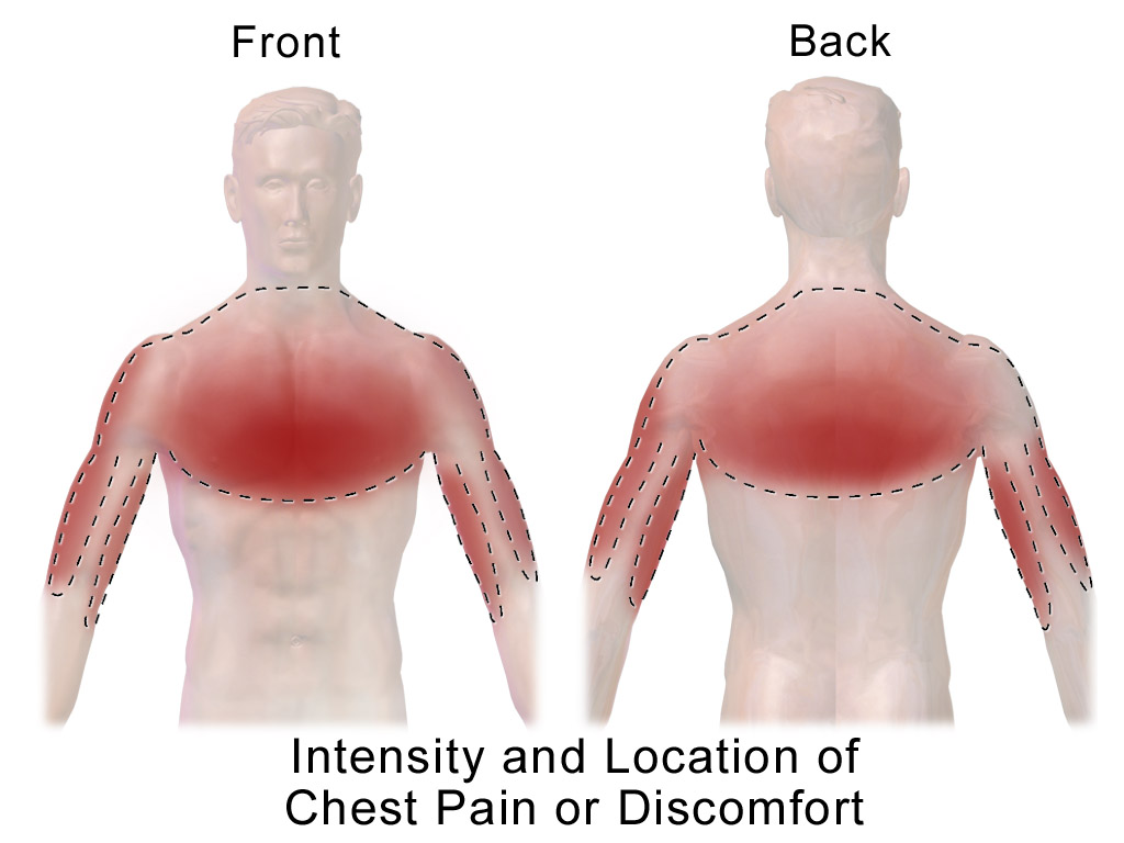 CHEST PAIN – A Sign of Heart Attack or is it Something Else?