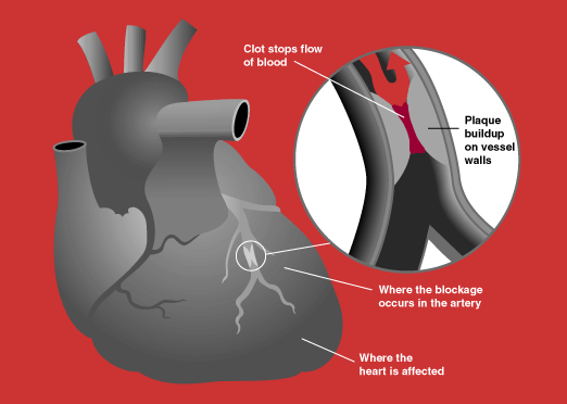 Common Warning Signs of a Heart Attack