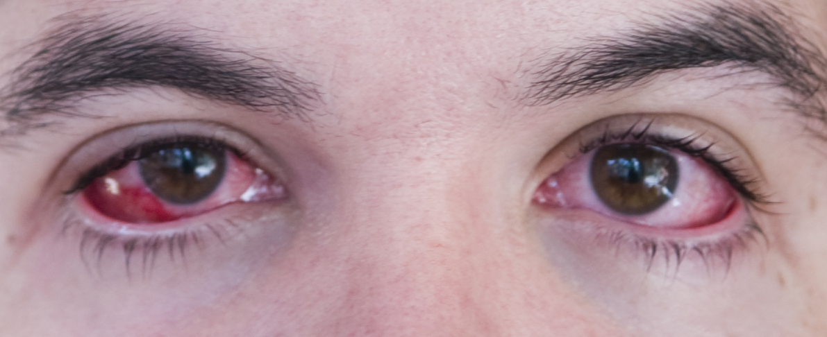 What are the First Signs of Conjunctivitis?