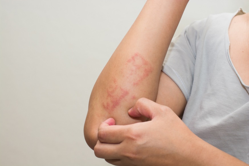 Contact Dermatitis: Causes, Symptoms, and Treatments