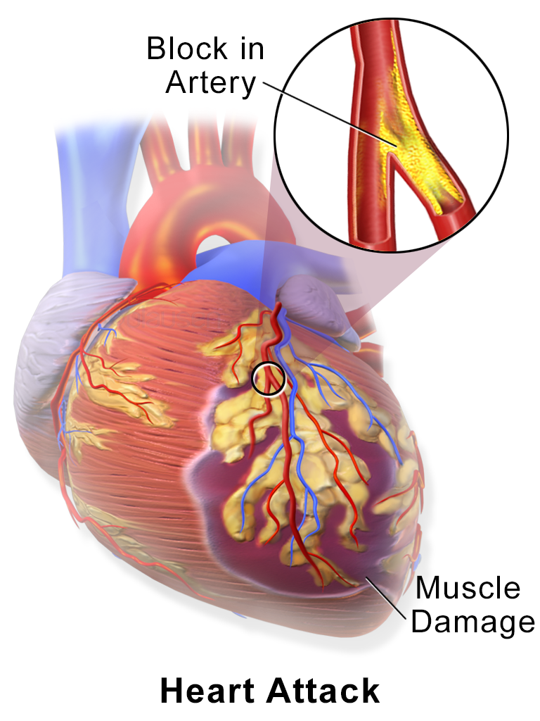 Heart Disease in Women