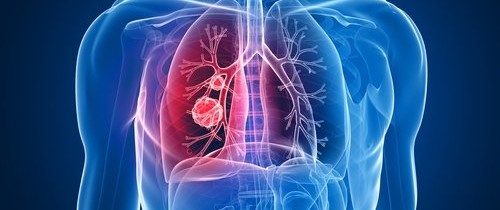 Interventional Radiology in Lung Tumors / Cancers