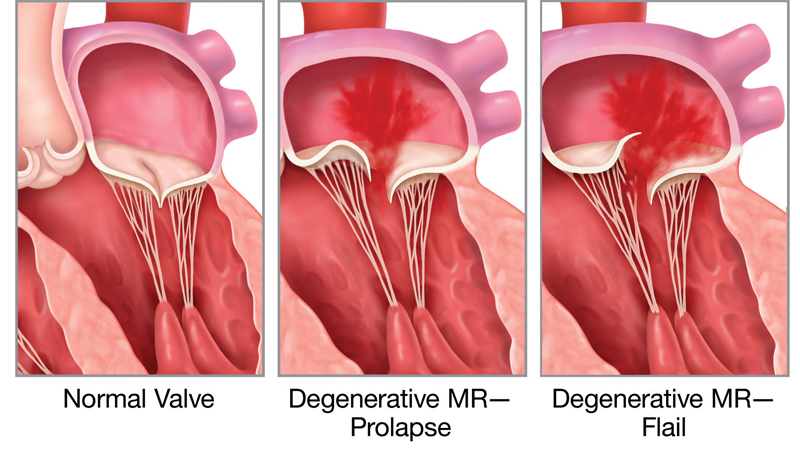 Mitral Valve Disease