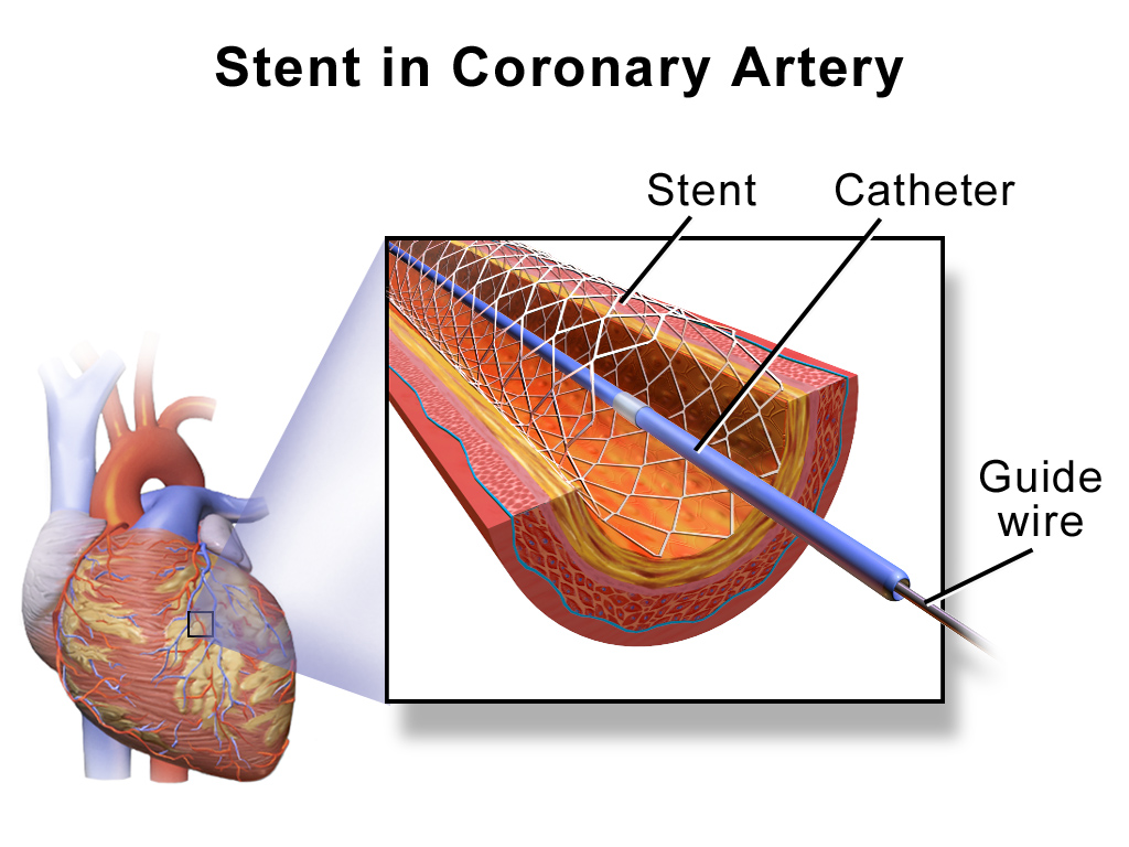 Percutaneous coronary intervention