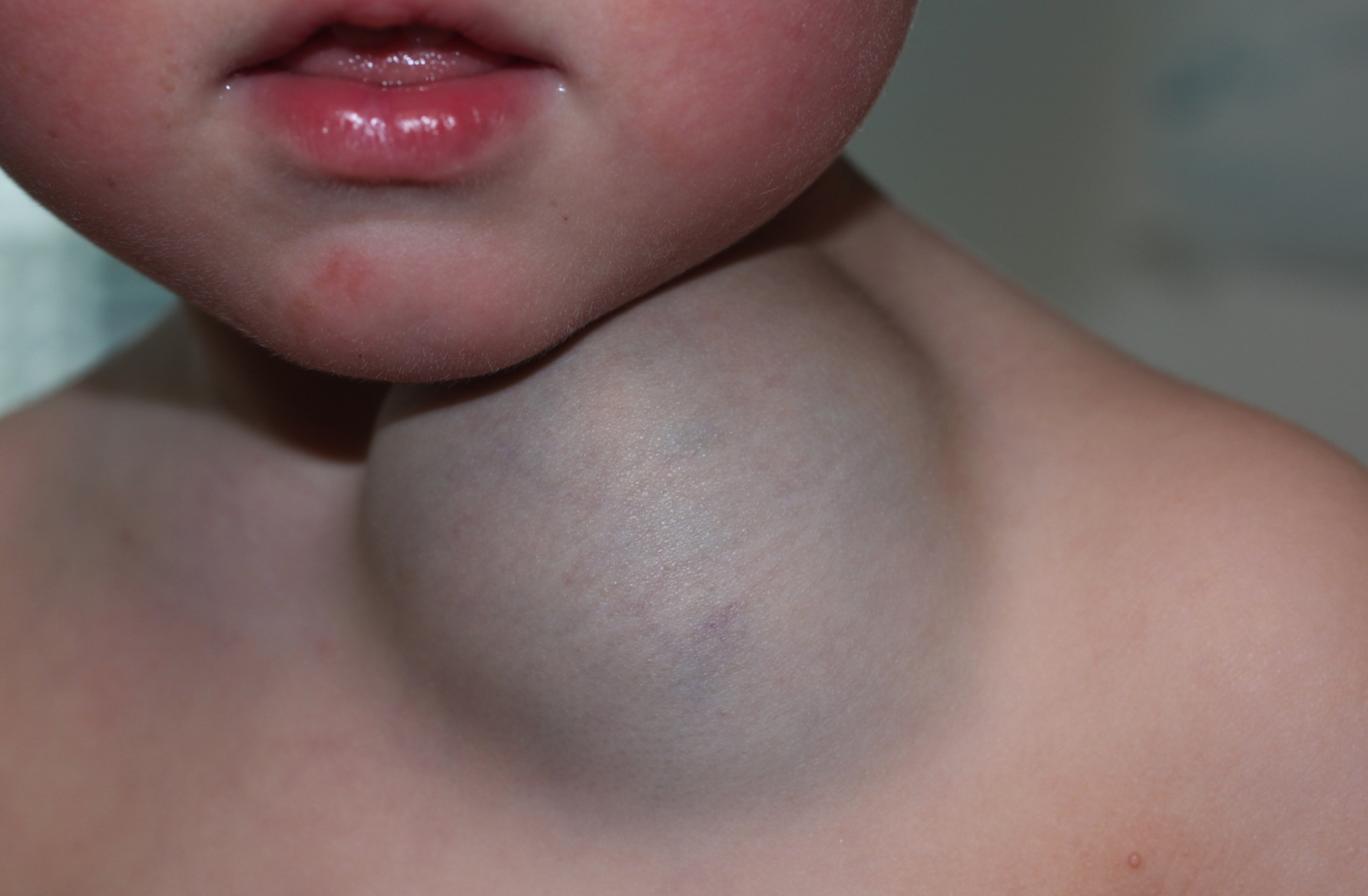 Vascular Malformations in Children